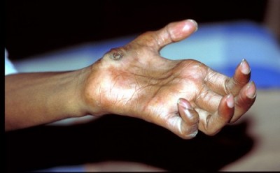 national conference on leprosy